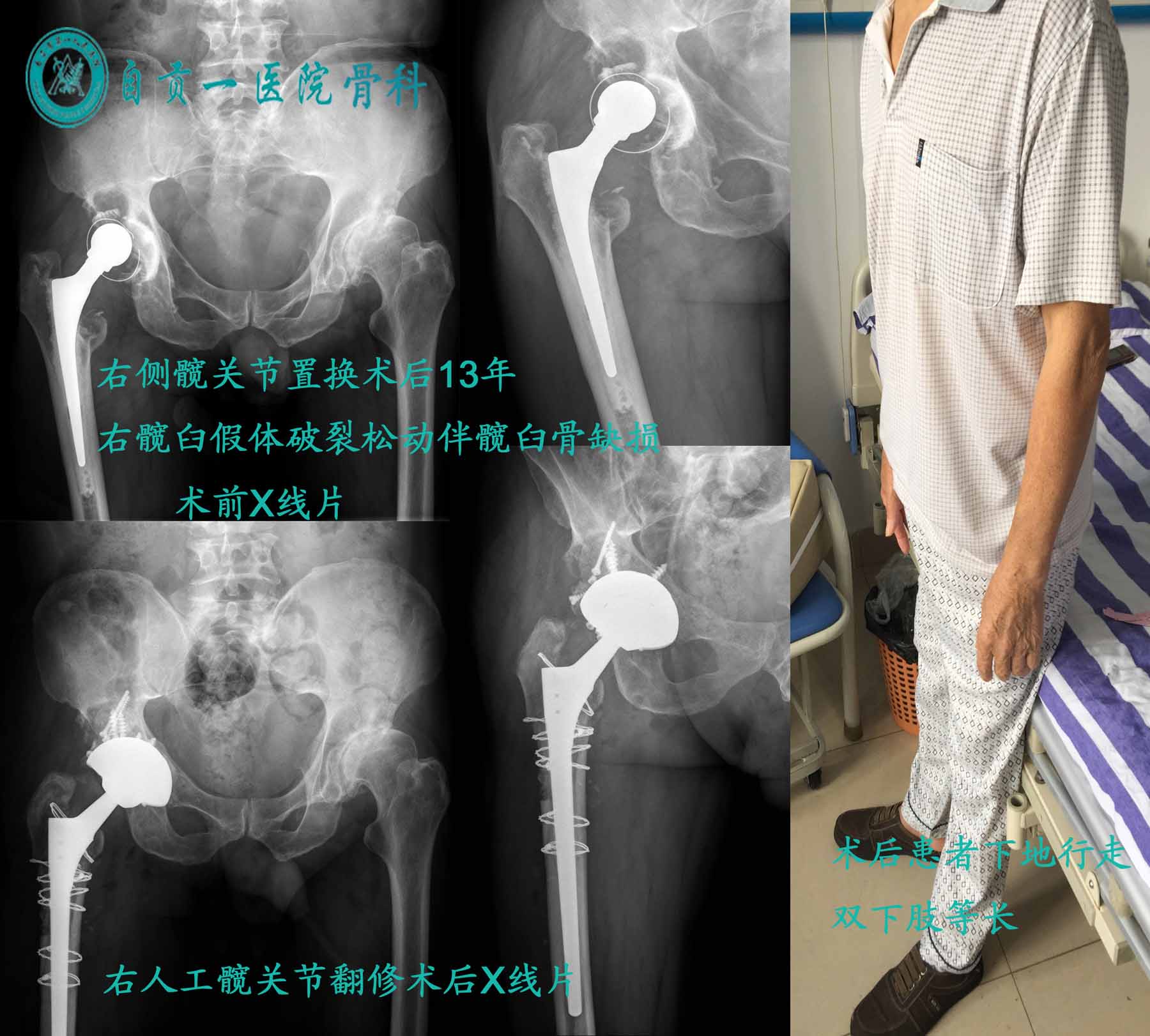 左侧人工全膝关节置换术后假体松动 - 聊城市中医医院