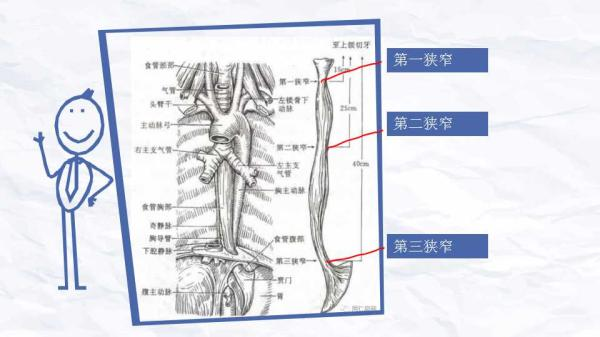 食管三个狭窄